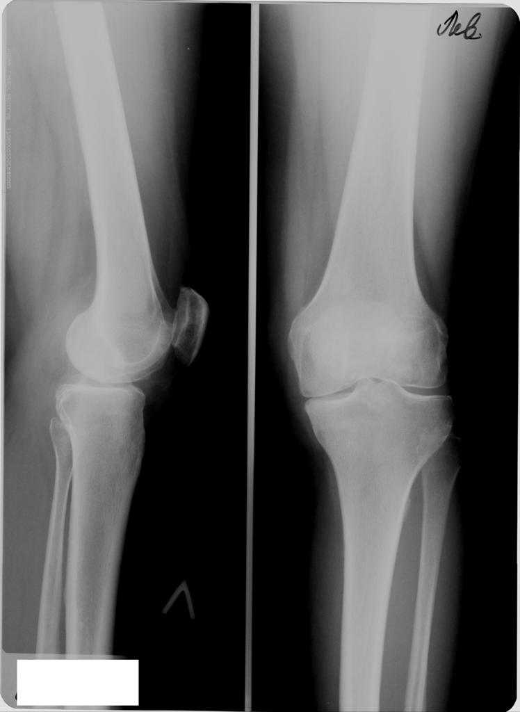 Смещение мыщелка. Рентген колена перелом надколенника. Смещение надколенника рентген. Вывих коленного сустава рентген. Перелом чашечки коленного сустава рентген.