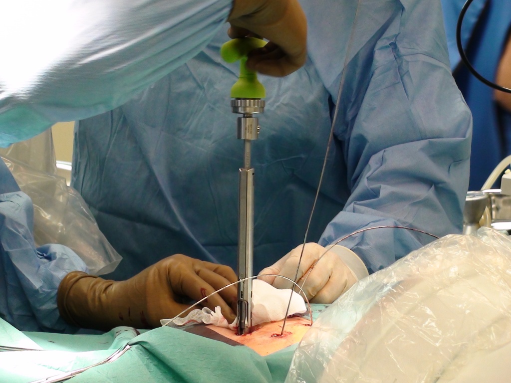 Операция без разрезания лапароскопия при язве